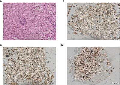 Case Report: Metastatic Signet-Ring-Cell Carcinoma of the Bladder From Breast Invasive Lobular Carcinoma Detected by Computed Tomography